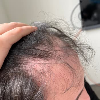 Saç Ekimi Sonrası Nekroz Ve Donör Bölgesi Problemleri Çözülmüyor