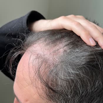 Saç Ekimi Sonrası Nekroz Ve Donör Bölgesi Problemleri Çözülmüyor