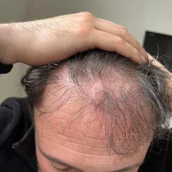 Saç Ekimi Sonrası Nekroz Ve Donör Bölgesi Problemleri Çözülmüyor