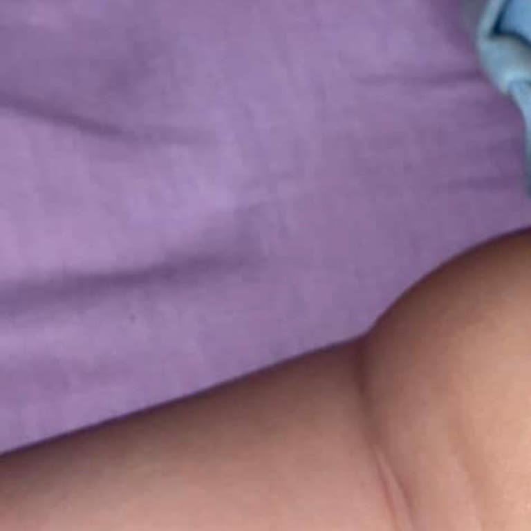 Mama Sandalyesi Bebeğimin Bacağını Sıkıştırdı Morarma Oldu