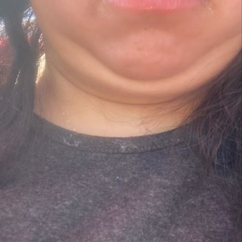 Gıdı Liposuction Sonrası Hiçbir Değişiklik Olmadı İlgisizlik Mağduriyet Yaşadım