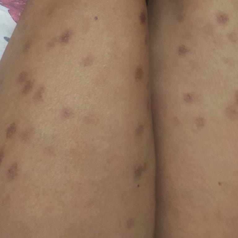 Lazer Epilasyon Sonrası Yanık Ve Ücret İadesi Sorunu
