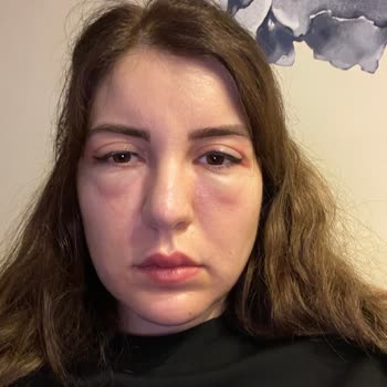 Yüz Germe Sonrası Şiddetli Şişlik Ve Morluk Yaşadım