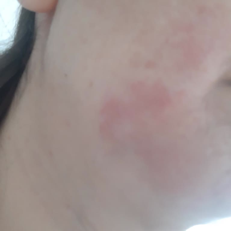 Жжение и шелушение от сыворотки Loreal Retinol для лица