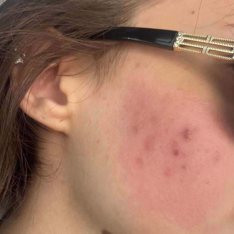 Жжение и покраснение от солнцезащитного крема Loreal Paris