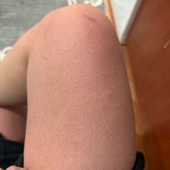 Tavuk Döner Tüketimi Sonrası Şiddetli Alerjik Reaksiyon Ve Hastane Tedavisi