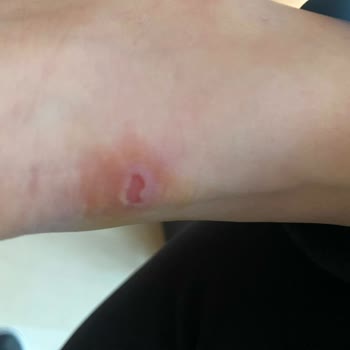 Aldığım Ayakkabı İlk Giyişte Ayağımı Yaraladı Para İadesi İstiyorum