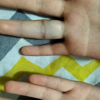 Kızımın Yaralanmasında Öğretmenin Sorumluluk Ve Üslup Eksikliği