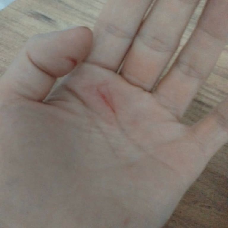 Sasu Konserve Kutularının Kesici Kenarları Nedeniyle Yaralanma