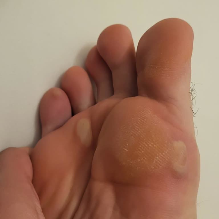 Pahalı Skechers Ayakkabı Oğlumun Ayaklarını Su Toplattı