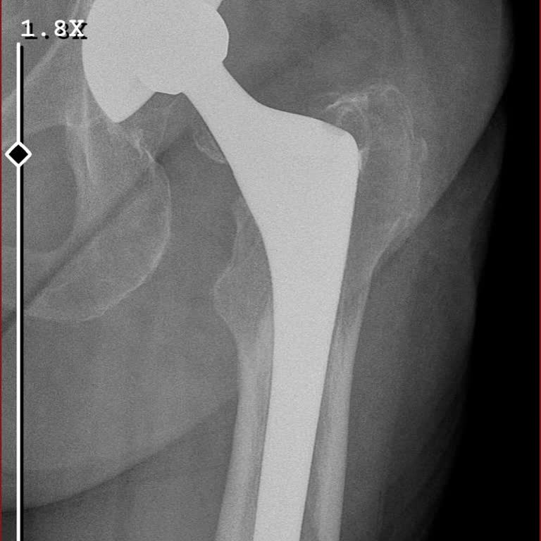 Acil Çıkış Kapısı Kazası Sonrası Yanlış Teşhis Ve Tedavi Mağduriyeti