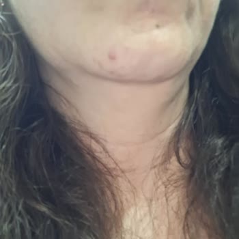 Pigment Bio Nemlendirici Ve Leke Karşıtı Güneş Koruyucu Sonrası Ciltte Şiddetli Sivilce Problemi