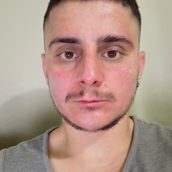 Garnier C Vitamini Temizleyici Yüzümde Yanma Ve Kabarmaya Sebep Oldu