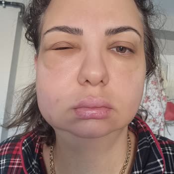 Endolift Sonrası Yüzümde Geçmeyen Ödem Ve İlgisiz Yaklaşım