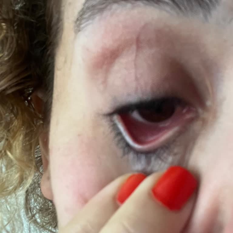 La Roche-Posay Makeup Remover Gel Burned My Eye—Severe Irritation for Hours