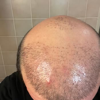 Esteuniversal Başarısız Saç Ekim İşlemi