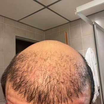 Esteuniversal Başarısız Saç Ekim İşlemi