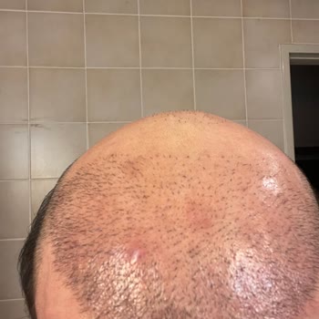 Esteuniversal Başarısız Saç Ekim İşlemi