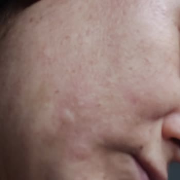 Yüzümde Kalıcı Hasar Ve İlgisiz Yaklaşım Sonrası Mağduriyet