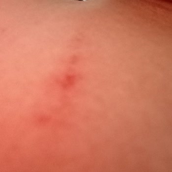 Butik Kopça Mağduriyeti