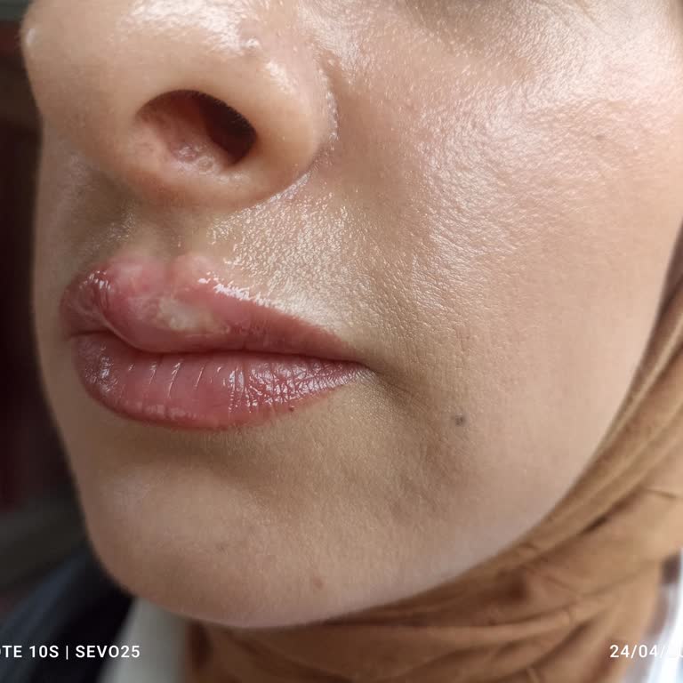 Yanlış Cihaz Başlığıyla Bıyık Bölgesinde Ciddi Yanık Oluştu