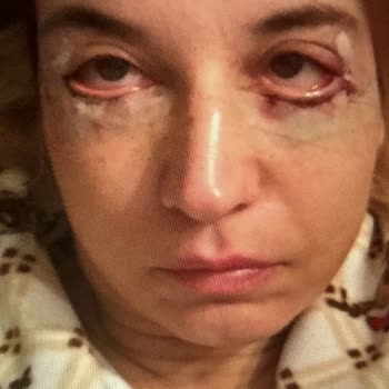 Göz Altı Ameliyatı Sonrası Yıllar Süren Mağduriyet Ve İlgisizlik