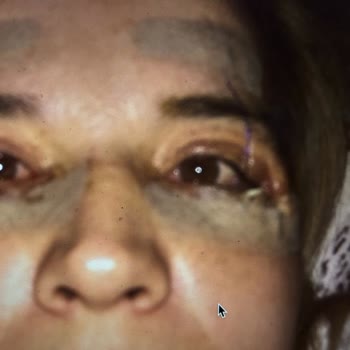 Göz Altı Ameliyatı Sonrası Yıllar Süren Mağduriyet Ve İlgisizlik