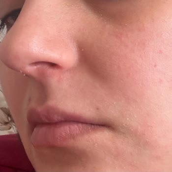 Bioderma Güneş Kremi Yüzümde Ciddi Tahrişe Sebep Oldu