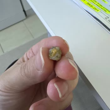 Kuruyemiş İçinden Taş Çıktı, Dişim Kırıldı