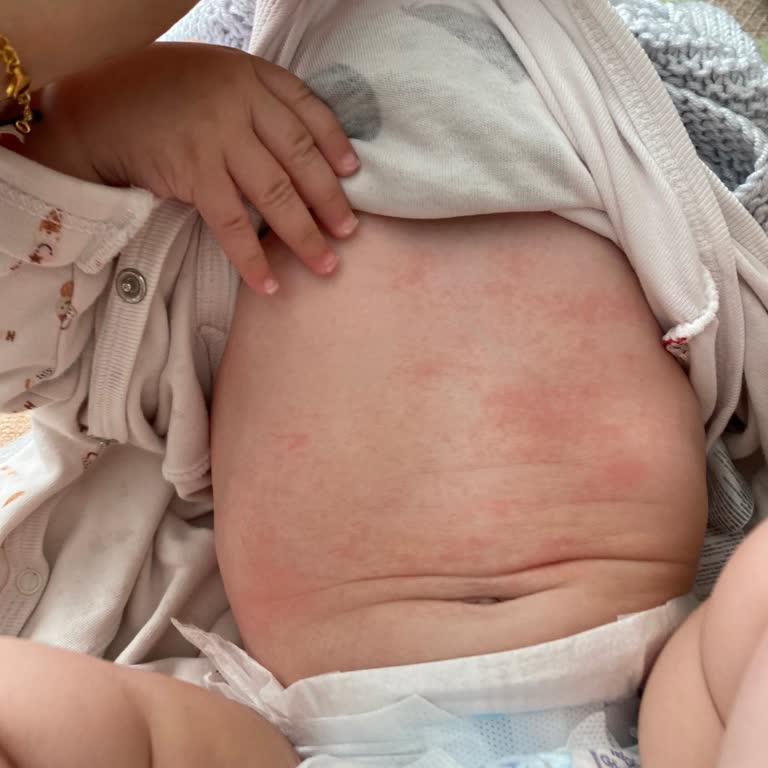 Mustela Ürünleri Bebeğimin Cildinde Atopik Dermatit Yaptı