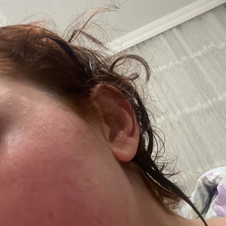 Loreal Paris Güneş Kremi Yüzümde Şiddetli Yanma Ve Acıya Sebep Oldu