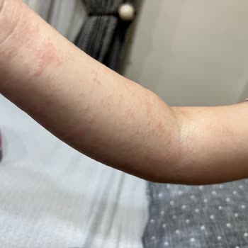 Liv Hospital'da Hemşire Hatası Sonrası Çocuğumun Kolu Zarar Gördü