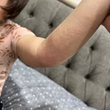 Liv Hospital'da Hemşire Hatası Sonrası Çocuğumun Kolu Zarar Gördü