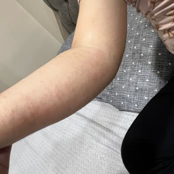 Liv Hospital'da Hemşire Hatası Sonrası Çocuğumun Kolu Zarar Gördü