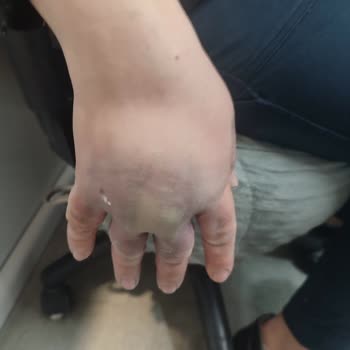 Acil Serviste İhmalkarlık Nedeniyle Elimi Kaybetme Tehlikesi Yaşadım