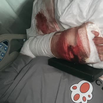 Acil Serviste İhmalkarlık Nedeniyle Elimi Kaybetme Tehlikesi Yaşadım