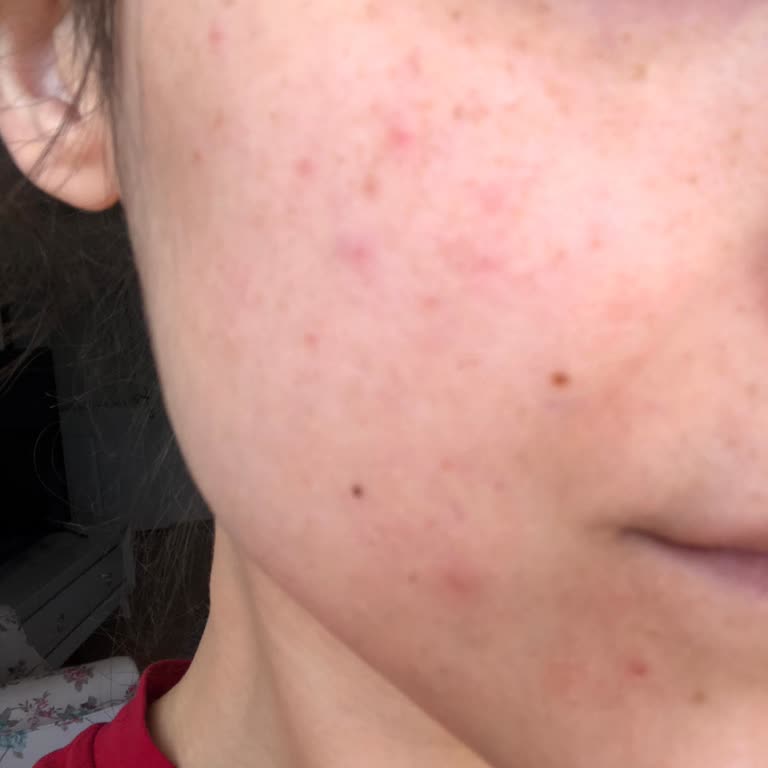 Hassas Ciltler İçin Aldığım Yüz Yıkama Jeli Sivilce Yaptı