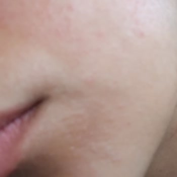 Ürün Sonrası Cildimde Komedon Ve Kırmızı Lekeler Oluştu