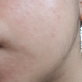 Ürün Sonrası Cildimde Komedon Ve Kırmızı Lekeler Oluştu