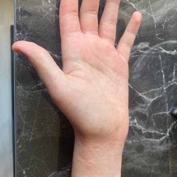 Decathlon Kaleci Eldiveni Çocuğumda Alerjik Reaksiyona Sebep Oldu