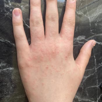 Decathlon Kaleci Eldiveni Çocuğumda Alerjik Reaksiyona Sebep Oldu