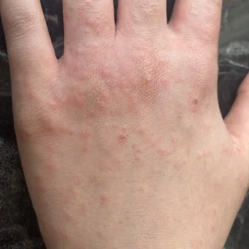 Decathlon Kaleci Eldiveni Çocuğumda Alerjik Reaksiyona Sebep Oldu