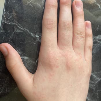 Decathlon Kaleci Eldiveni Çocuğumda Alerjik Reaksiyona Sebep Oldu