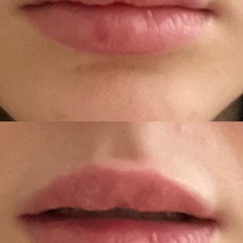 Dr. Yavuz Selim Çınar Orantısız Dudak Dolgusu