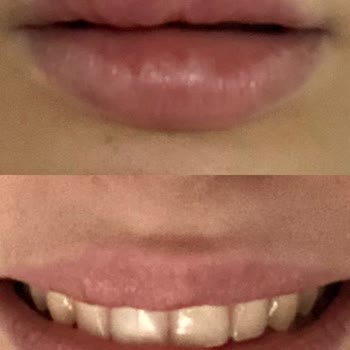 Dr. Yavuz Selim Çınar Orantısız Dudak Dolgusu