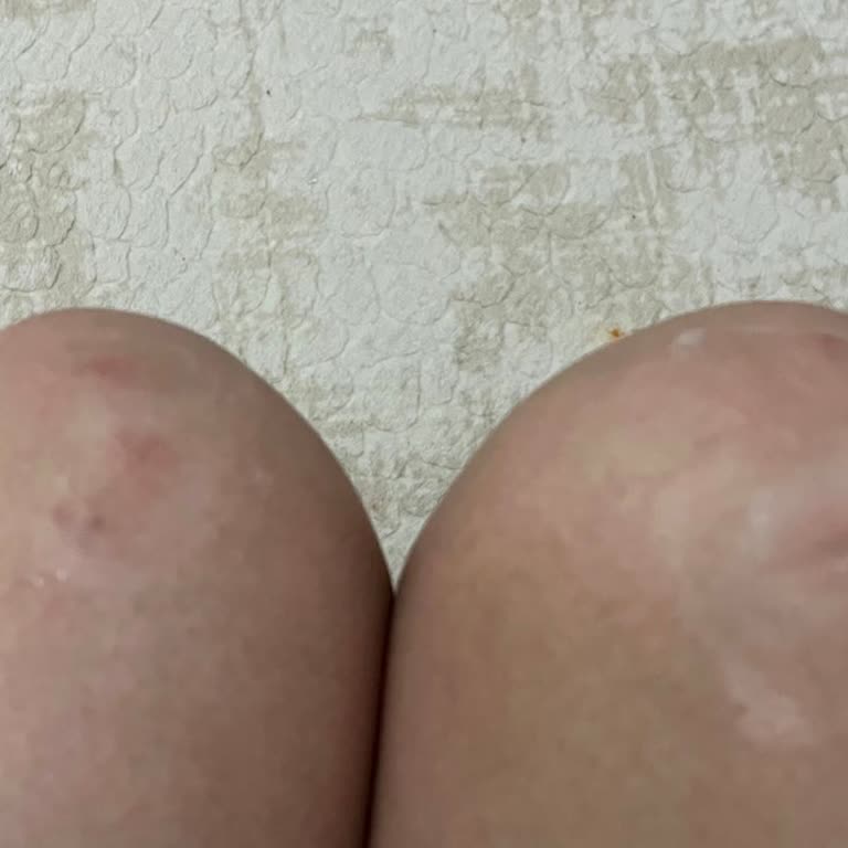 Lazer Seansı Sonrası Yanık Ve İlgisizlik