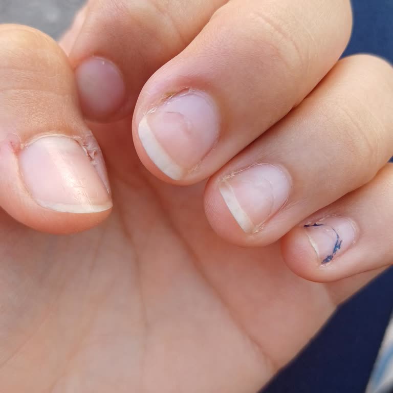 Protez Tırnakta Acı Ve Hastalık: Hem Zarar Hem Azar!