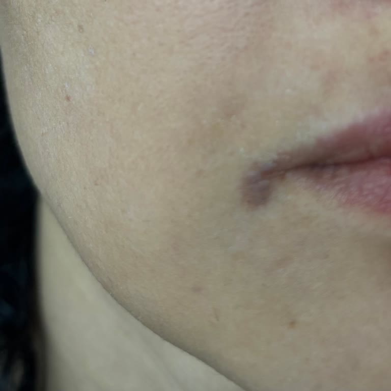 Esse Life Ankara Beytepe Yüzüme Lazer Yaparken Dudağımın Kenarını Yaktılar