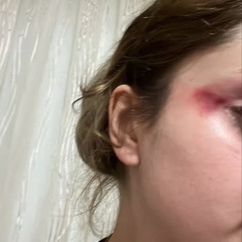 Saç Kurutma Makinesi Parçası Gözüme İsabet Etti, Yaralanma Riski Oluştu