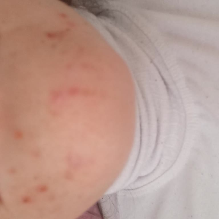 Kiehl's Retinol Seti Sonrası Çenemde Ağrılı Sivilceler Oluştu